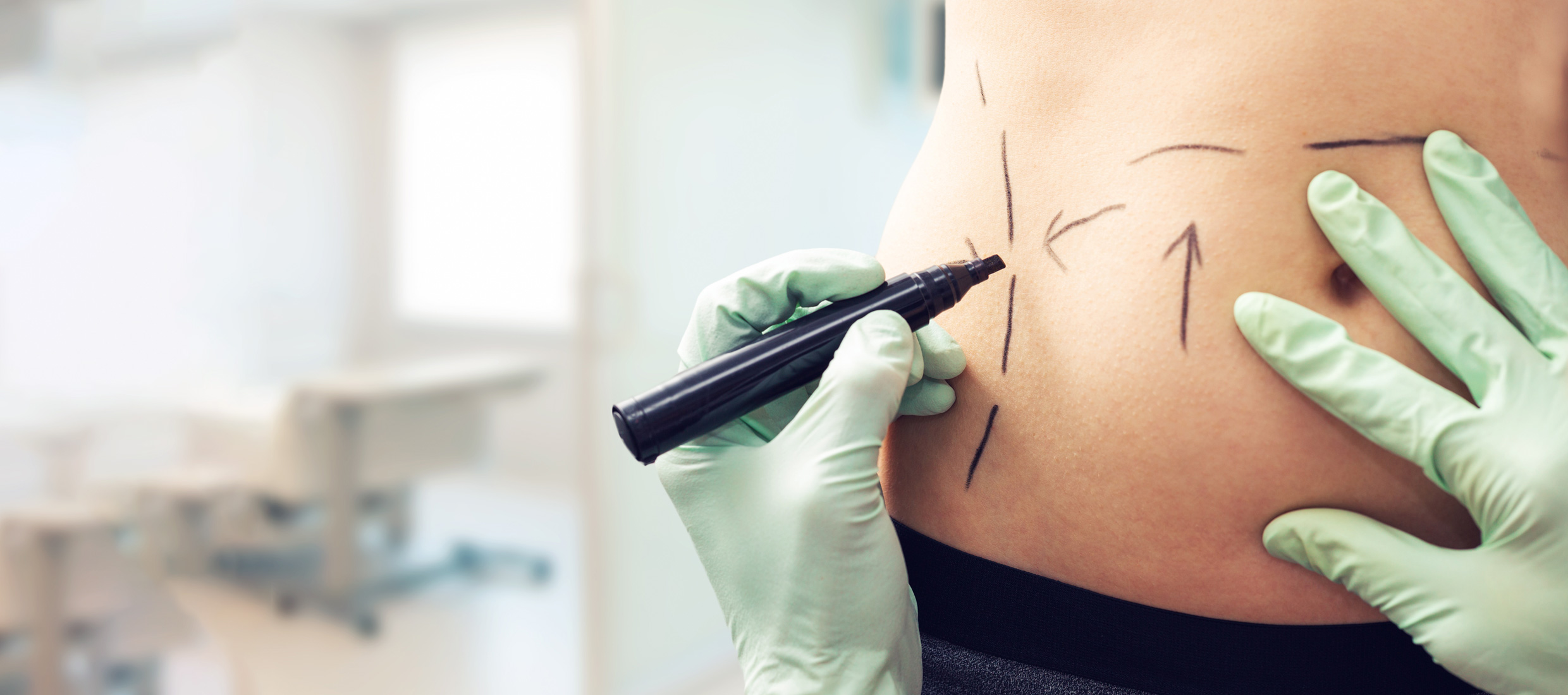 A Keck Medicine plastic surgery expert with green gloves draws arrows and lines in black marker around a woman's navel